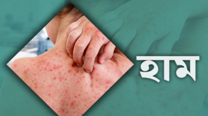 হাম ও উপসর্গে এ পর্যন্ত মৃত্যু ৪৯৯, ঢাকায় সর্বোচ্চ ২১০